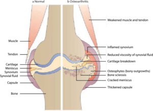 Osteoarthritis