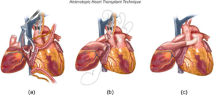 Heart Transplant