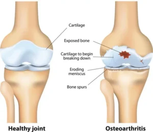 Osteoarthritis