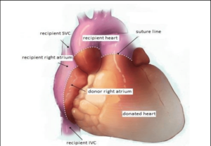 Heart Transplant