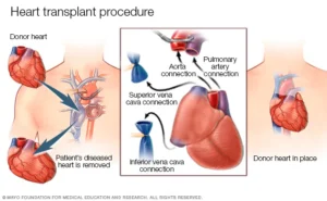 Heart Transplant