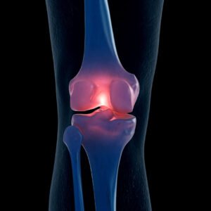 Osteoarthritis 