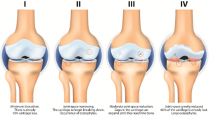 Osteoarthritis